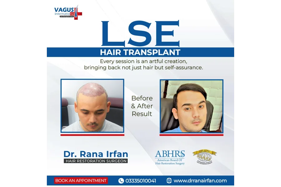 FUE Hair Transplant by Dr Rana Irfan